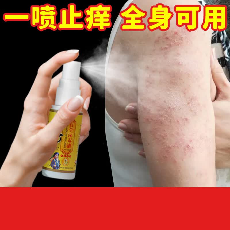夏天皮肤止痒喷雾身上起红疙瘩痒小腿天热出汗全身瘙痒喷剂王 1瓶