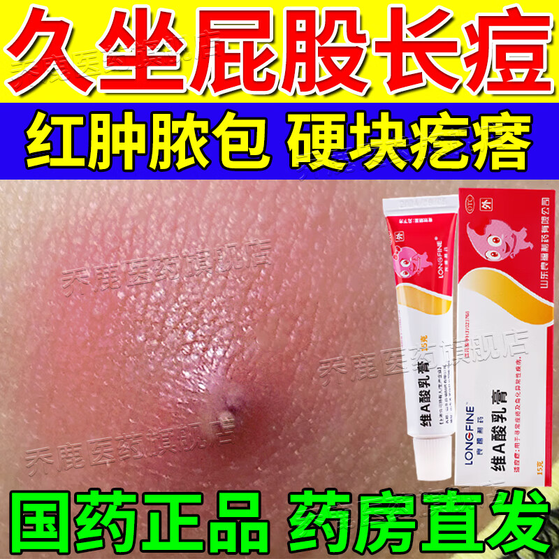 坐板疮用药膏 屁股瘙痒久坐屁股长红疙瘩长痘痘脓包痘流脓毒气疙瘩