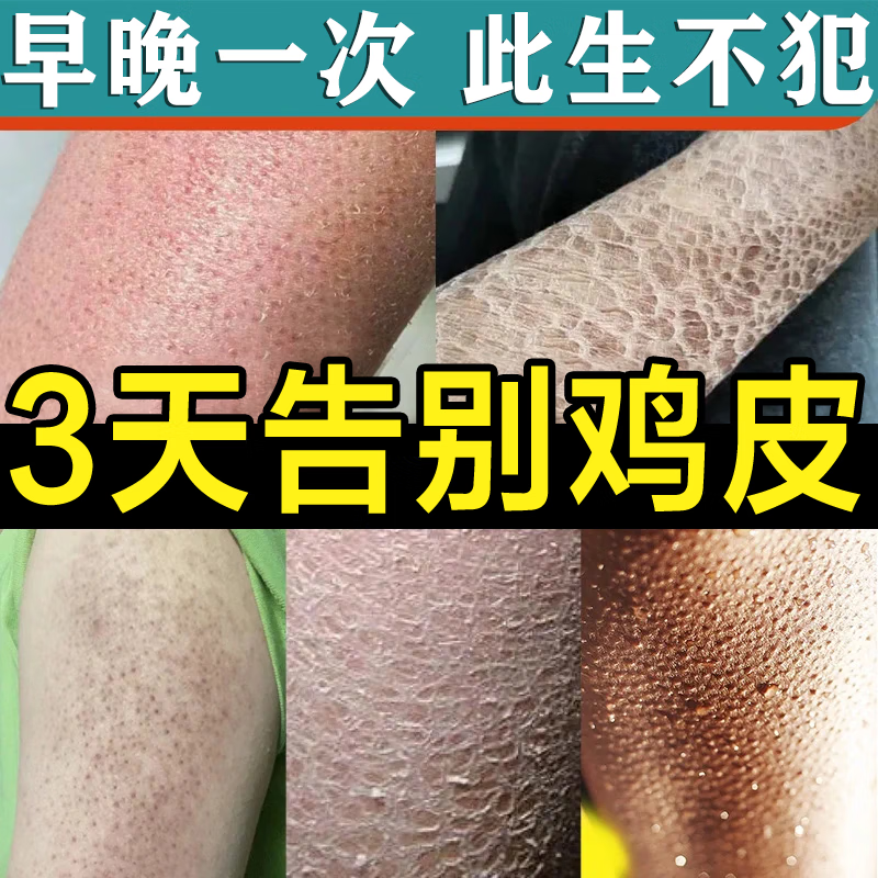 鸡皮肤疙瘩毛囊角化症专用贴药大腿 手臂疙瘩鸡皮肤死皮去除神器 一