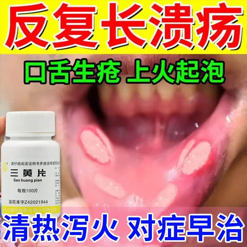 治口腔溃疡的药 上火嘴巴烂口腔溃疡口舌生疮溃烂舌头起泡红肿疼痛