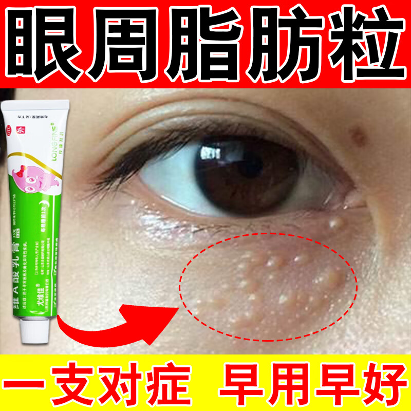 维a酸乳膏 脂肪粒药膏用于眼周脂肪粒油脂粒汗管瘤眼睛周围有白色颗粒