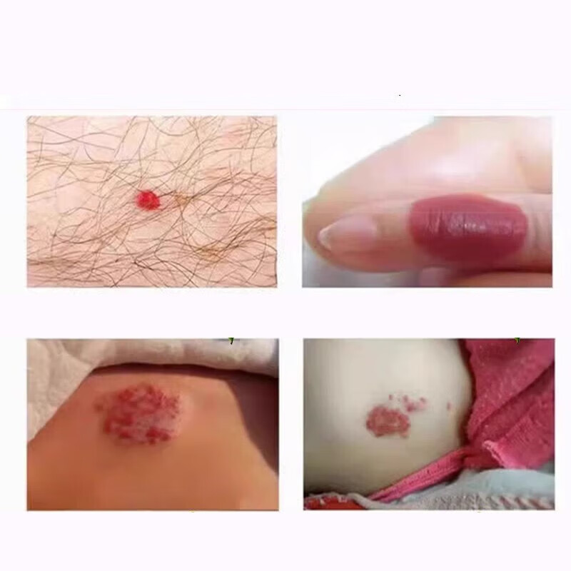消瘤散结膏适用于血管痣状血管瘤红血丝 单盒体验装