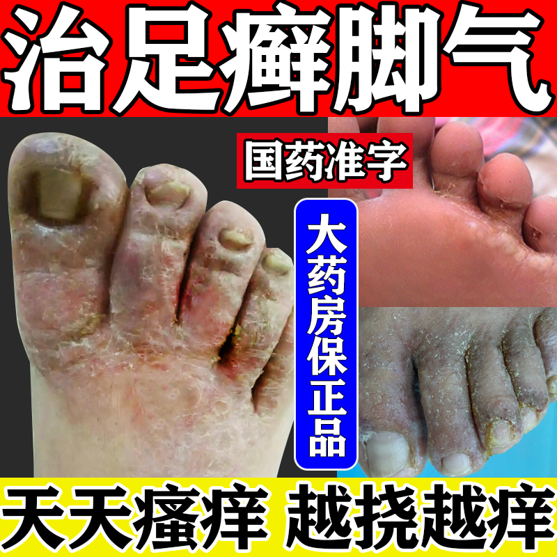 脚气药止痒脱皮烂脚丫真菌感染止痒 脚气治脚气的特药烂脚丫药脱皮