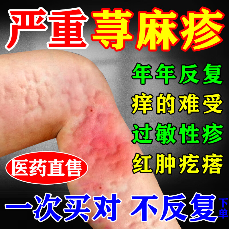 肤痒颗粒荨麻疹专科用药 反复荨麻疹过敏祛风止痒药 一盒【荨麻疹药】