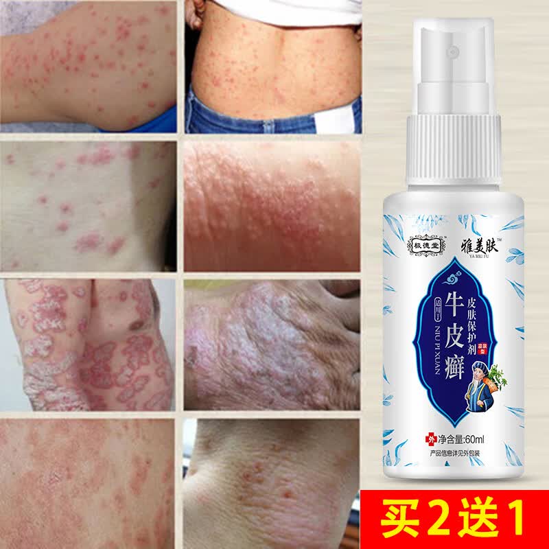 手足藓痒清皮炎湿疹牛皮癣专用苗药顽固牛皮癣银屑i病皮肤癣喷剂体癣药水股癣痒净花斑癣真菌感染疥疮专用膏 癣王喷剂+疥疮膏一支