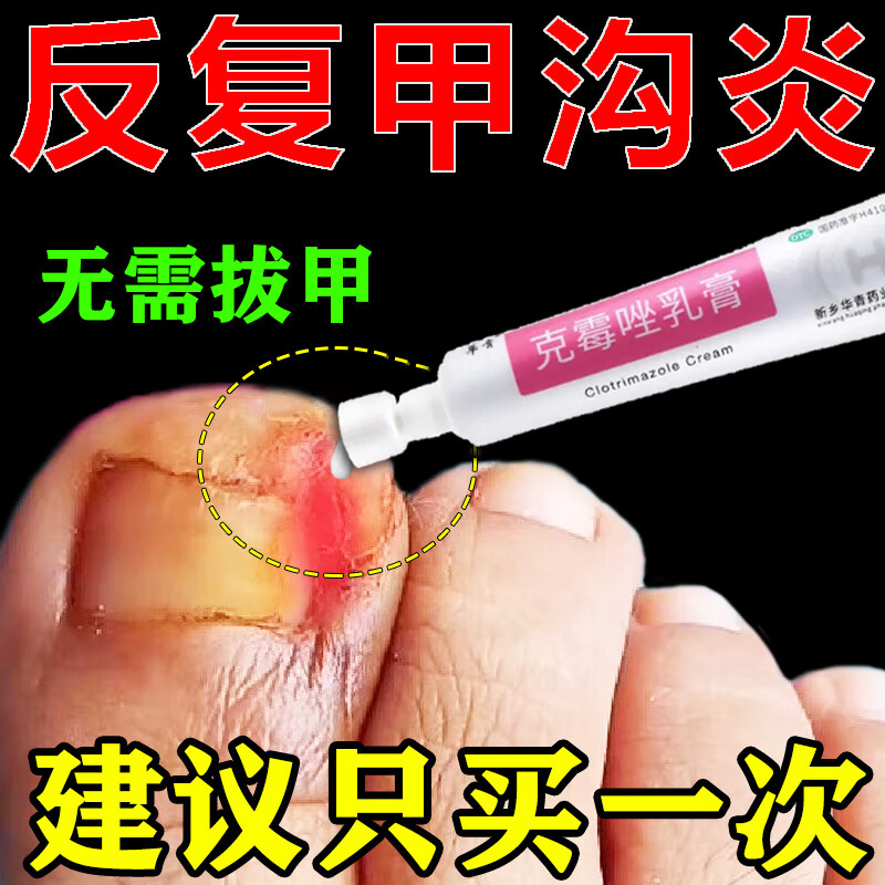 华青 克霉唑软膏 甲沟炎用药治疗甲沟炎用药肉芽甲沟炎消专肿用药走路