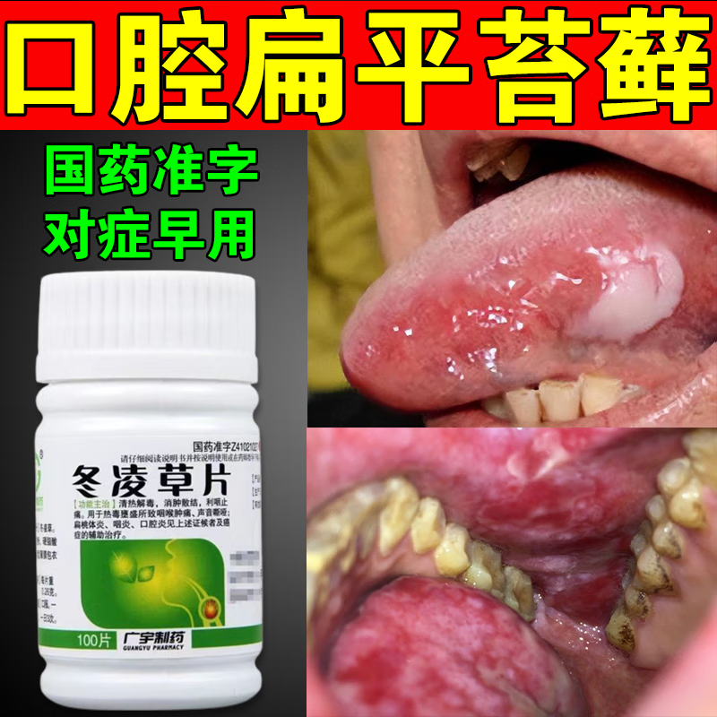 鹅口疮充血糜烂斑片水疱肿痛的治疗药物 冬凌草片 1盒装【国药准字】