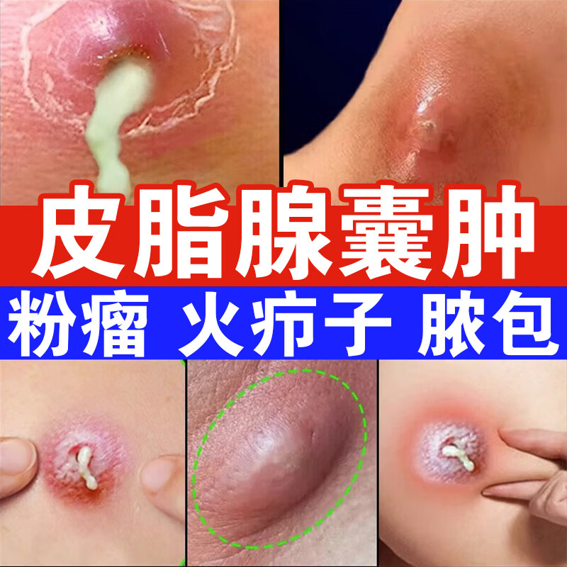 粉瘤消除膏治皮脂腺囊肿专用药粉瘤红肿脓包皮下痘痘粉瘤增生火疖子有