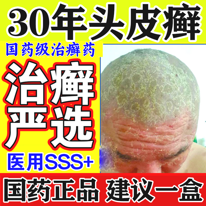 硝酸咪康唑乳膏 头癣药 膏 头皮癣脂溢性皮炎银屑头皮屑头上长疙瘩