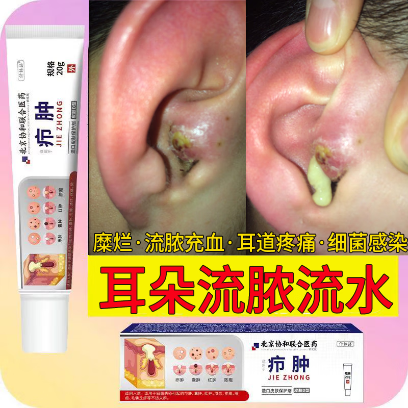 火疖子专用软膏外耳道真菌感染可搭疖肿拔毒膏脓包疙瘩皮脂腺囊肿拔脓