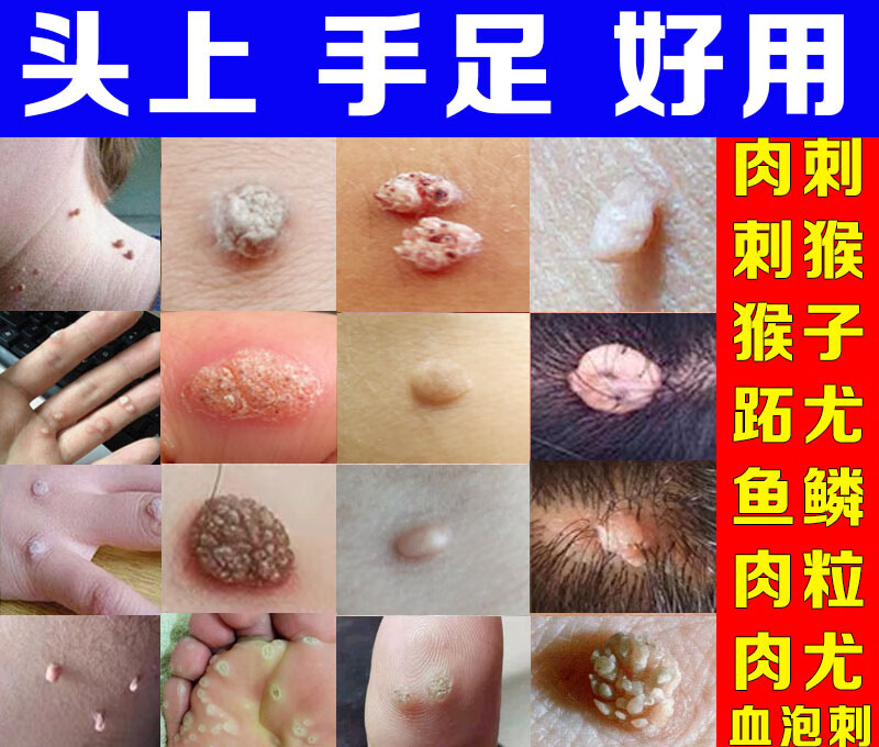 治瘊子的药肉刺去除膏刺猴去除点取鱼鳞痣贴头跖疣老鼠净 跖疣老 跖疣