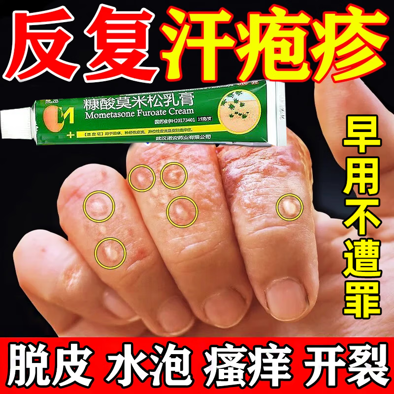 水泡脱皮真菌感染皮肤用药止痒瘙痒皮炎湿疹手指钻心痒脱皮干裂特傚药