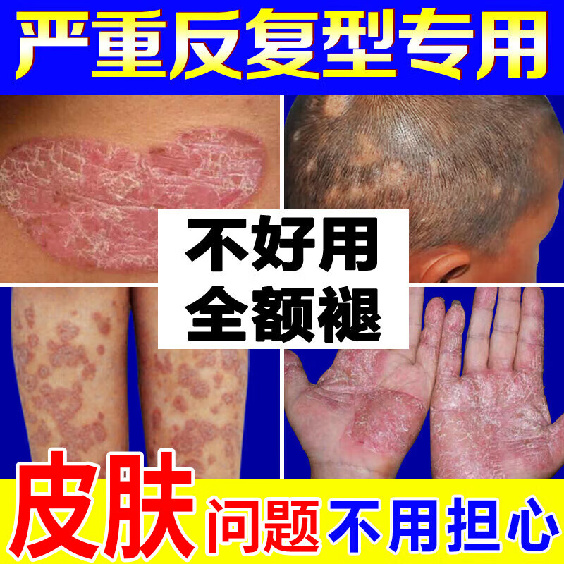 民间郎中苗癣王顽固牛皮癣专用皮肤瘙痒银屑药皮炎股癣特湿疹膏真菌止痒病效牛皮藓抑菌皮肤大腿内侧止瘙痒膏根手足头鲜癣立净