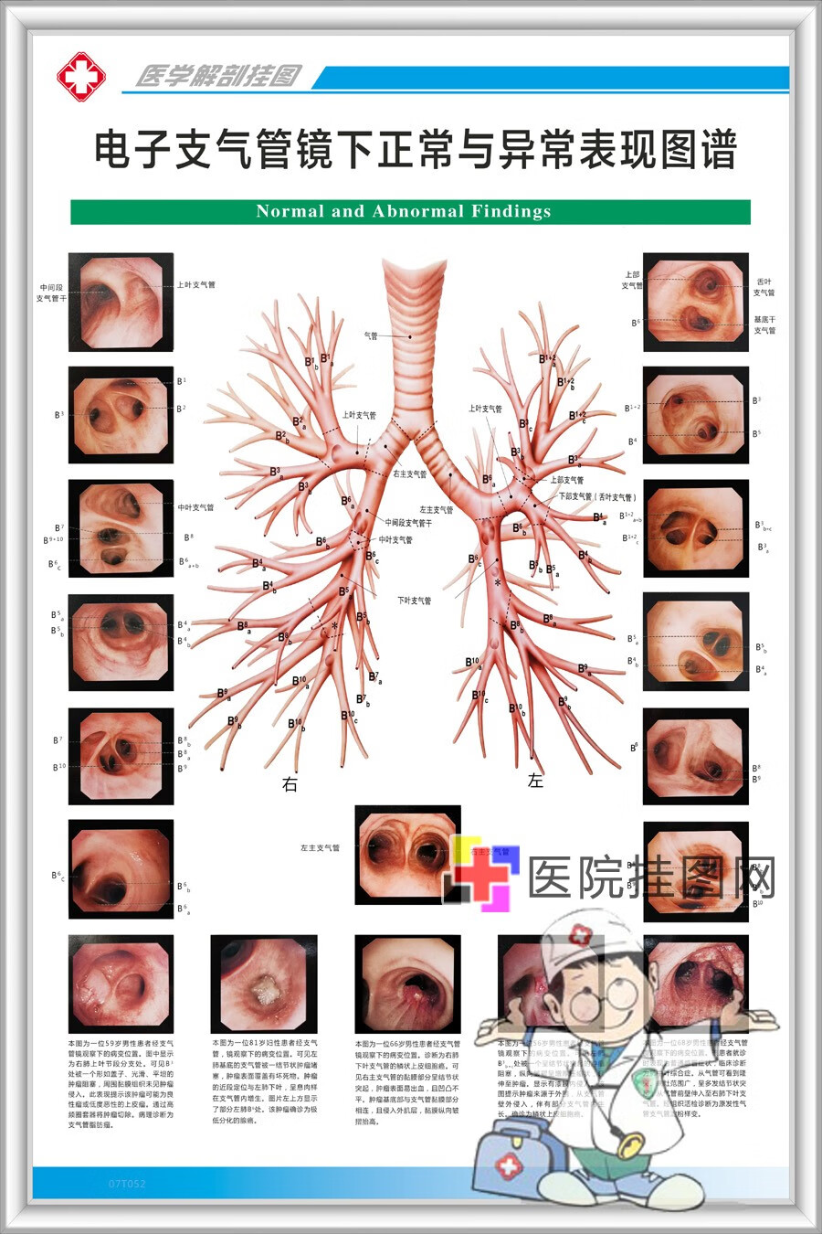 肺部支气管解剖结构图图片