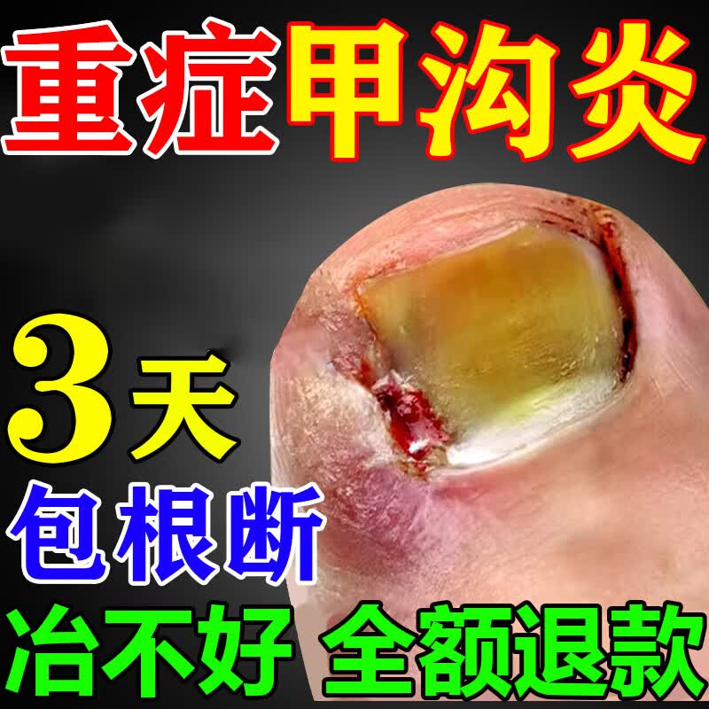甲沟炎专用的根i治消肿去肉芽甲沟炎药i膏矫正嵌甲不长肉里神器 #买2