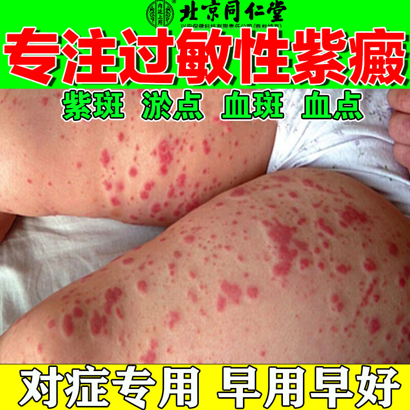 同仁堂过敏性紫癜的治疗外用药紫癜性消除红色瘀斑血斑血点膏皮下出血