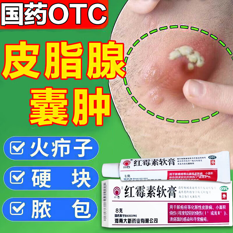 红霉素软膏 皮脂腺囊肿药膏 火疖子拔毒药膏 治头部颈部前胸后背脓包