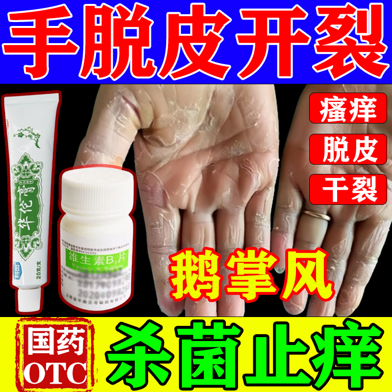治鹅掌风手足癣症】手掌反复脱皮手足干裂药治皮肤开裂手真菌感染脱皮