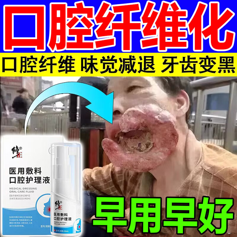 口腔纤维化修复槟榔口腔溃疡修复液黏膜纤维化修复黏膜白斑糜烂味 单