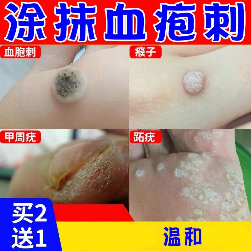 疗血胞刺的跖疣膏血泡刺贴脚底鸡眼甲周疣手脚上长硬疙瘩瘊子 单盒