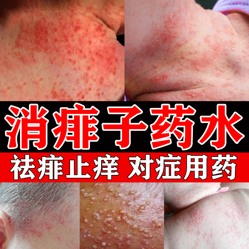 痱子药幼儿宝宝成人通用非药膏红粉色 炉甘石洗剂 1盒【治痱子瘙痒】