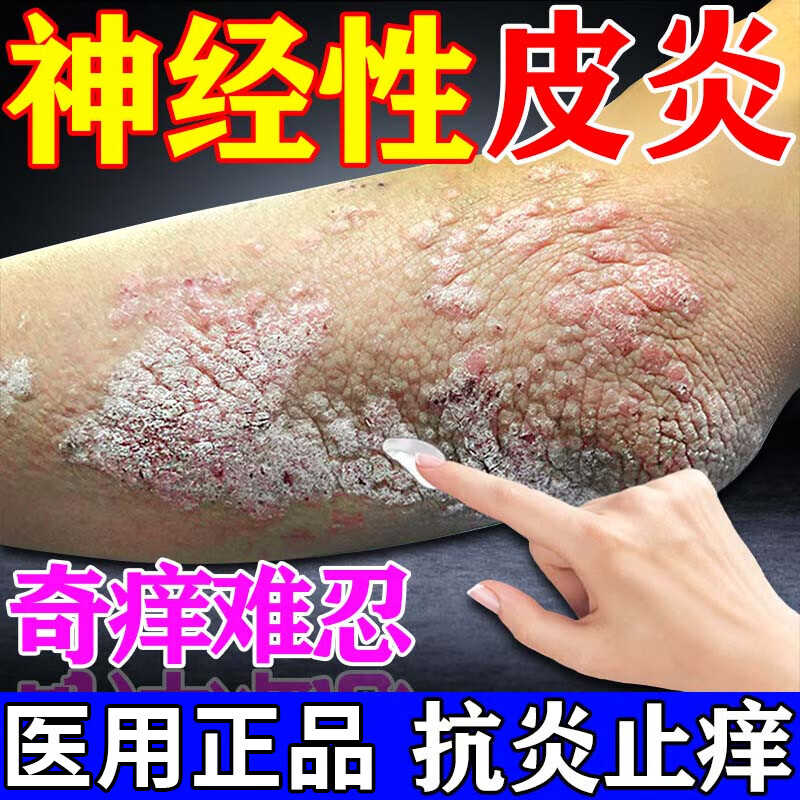 皮肤瘙痒皮炎湿疹皮癣真菌感染治痒膏红斑丘疱疹 接触性神经性皮炎手