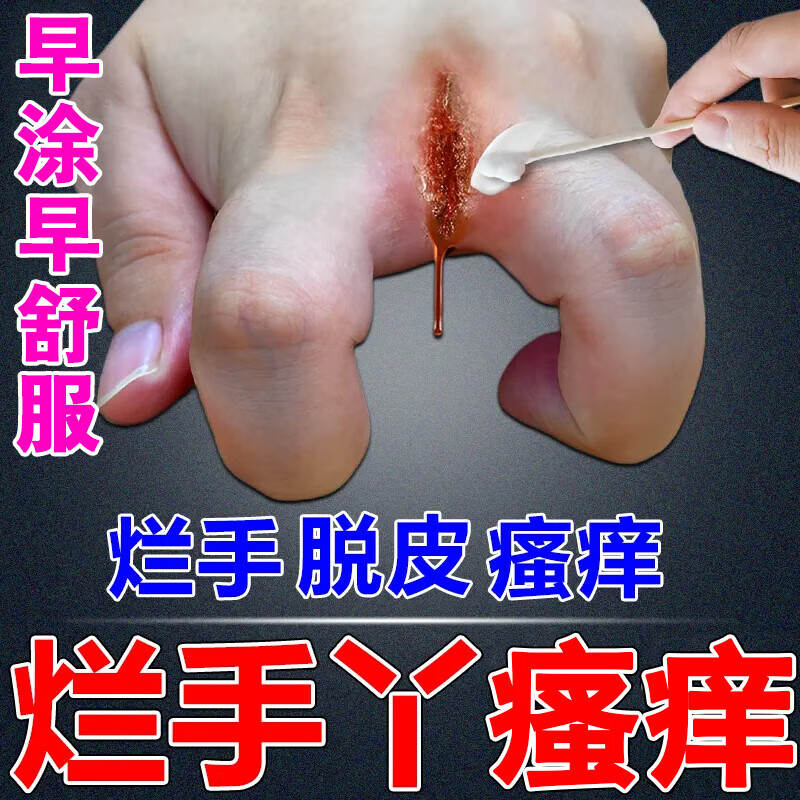鹅掌风烂手丫手指缝溃烂红肿起水泡红疹瘙痒皮炎湿疹曲咪新乳膏专用药
