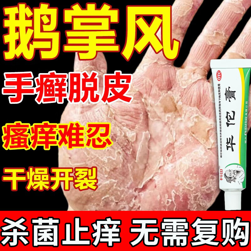 治鹅掌风药膏干裂脱皮手癣膏手掌粗糙变厚脱皮开裂真菌感染用药脱屑