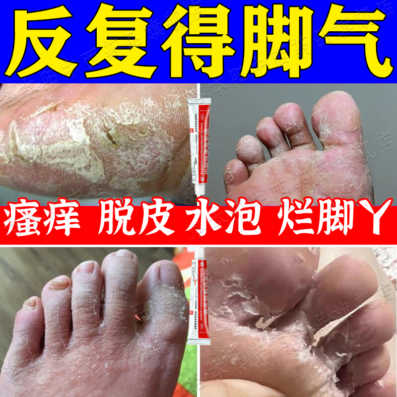 治脚气药治痒脱皮烂脚丫真菌感染 脚臭出汗脚缝痒烂成片水泡脚底发白