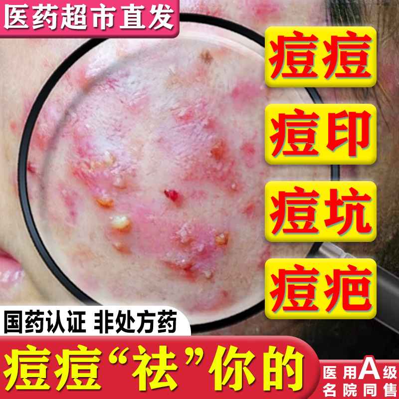 硫软膏脸上长痘痘专用otc药青春期祛痘印修复淡化痘印痘坑修复药膏去