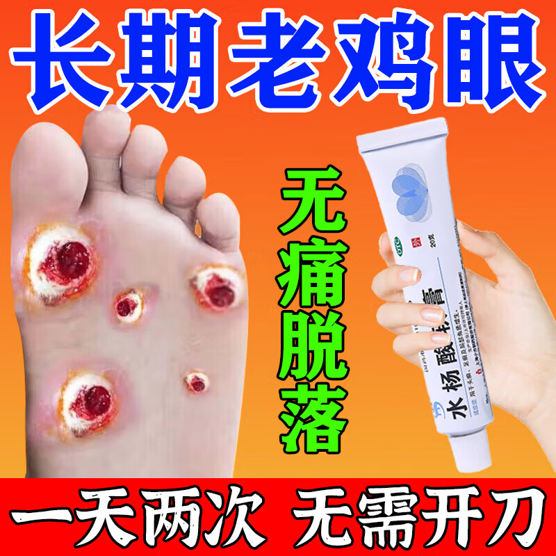 药膏无痛脱落治成人脚底脚趾鸡眼刺猴跖疣瘊子老茧走路疼痛水杨酸软膏