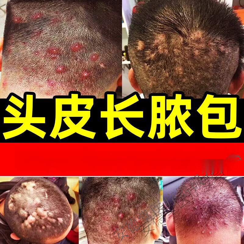 头上长疙瘩脓包头皮毛囊药专用鸡皮疙瘩毛囊焱头皮长红疙瘩痘痘脓包
