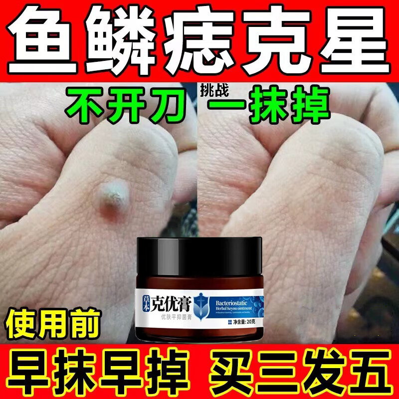 非药疣猴灵去除脖子小肉粒疙瘩拓疣手指上长猴子血胞刺扁平疣老鼠痣