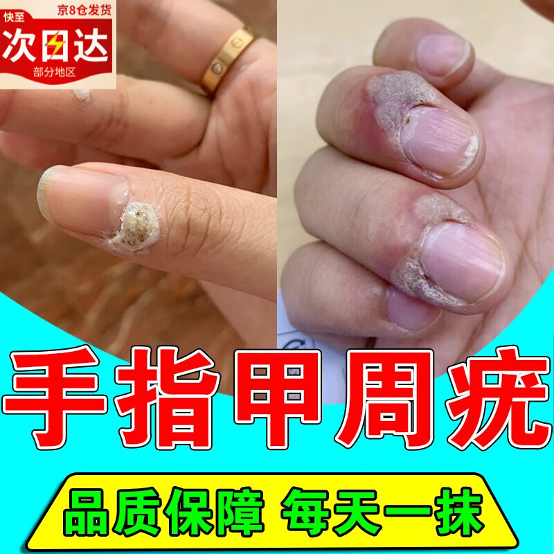 儿童甲周疣手指专用甲下疣增生去除膏大人脚趾跖疣甲沟疣 单盒装建议