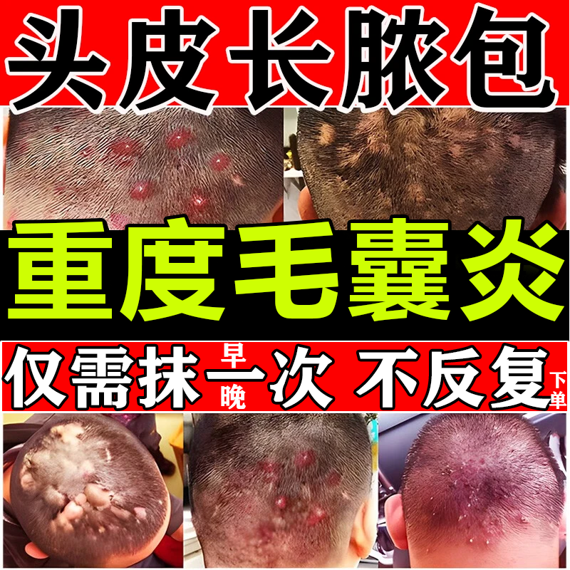 毛囊炎头部专用药毛囊炎药膏头皮痒有疙瘩发红头上长疙瘩脓包头皮毛囊