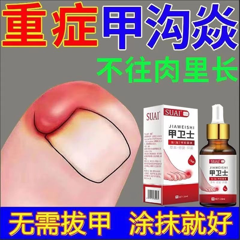 去肉芽脚趾甲往肉里长红肿疼痛化脓嵌甲液 【重度甲沟炎】好后不再犯