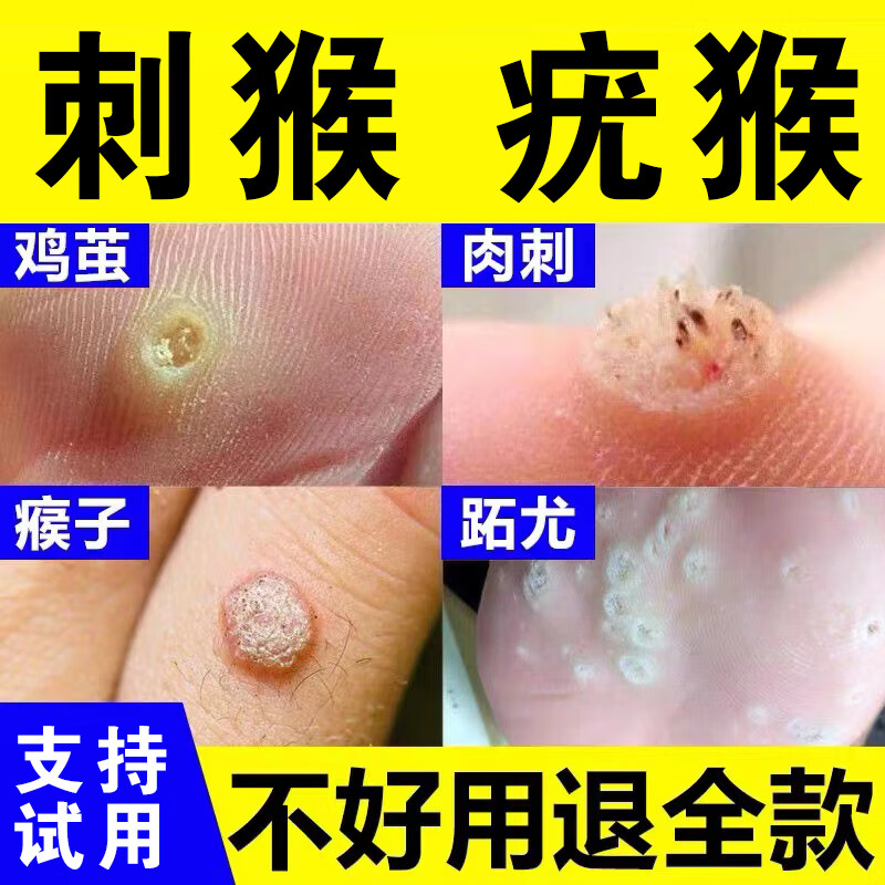 拓疣鸡眼鱼鳞痣扁平疣肉刺手脚脖子通用液体敷料膏 1盒装(轻微症状)
