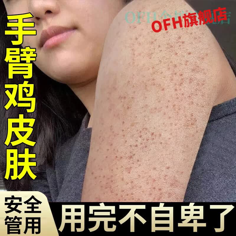 贝因维丝(beiyvs)去鸡皮肤毛囊炎磨砂膏鸡皮疙瘩毛囊角化膏手臂毛孔
