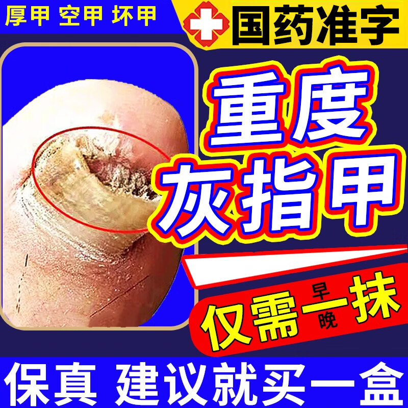 伊曲康唑成人抗真菌药灰指甲 可选硝酸咪康唑乳膏 灰指甲专用药特灰效