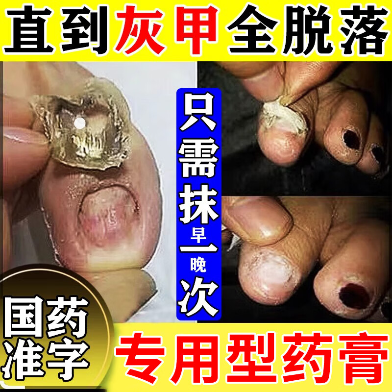 正品灰指甲抑菌真菌感染脱甲坏甲皮肤用药亮甲 达克宁硝酸咪康唑乳膏