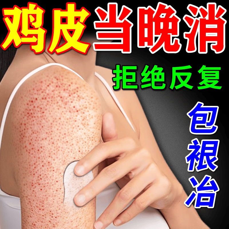 康蜂园鸡皮肤疙瘩毛囊角化症专用的药大腿手臂身体乳治鸡皮疙瘩去除