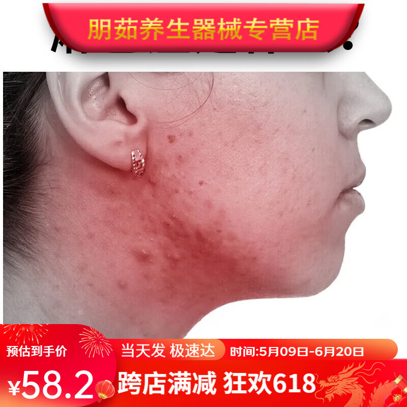 淋巴痘凝胶适用于腮边痘下巴疙瘩红肿硬块痘痘i炎腮帮子长痘凝 【单盒