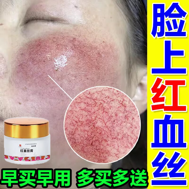 邹润安去皮肤红血丝修复角质层薄敏感肌修复面部泛红复去除红皮肤血丝