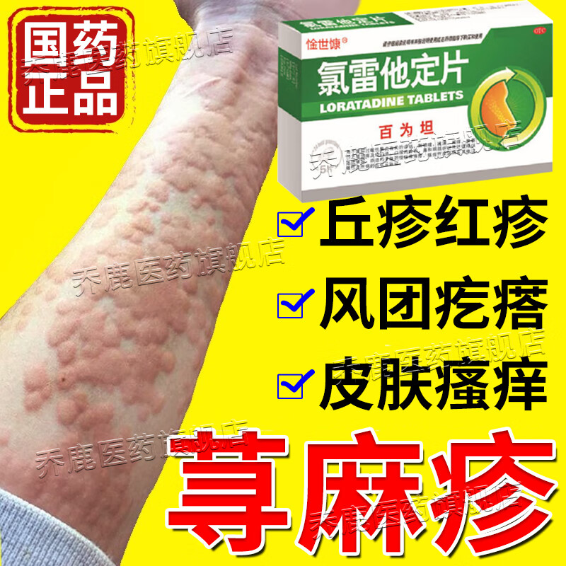 氯雷他定片 缓解慢性荨麻疹专用药过敏瘙痒止痒根皮肤瘙痒性皮肤病