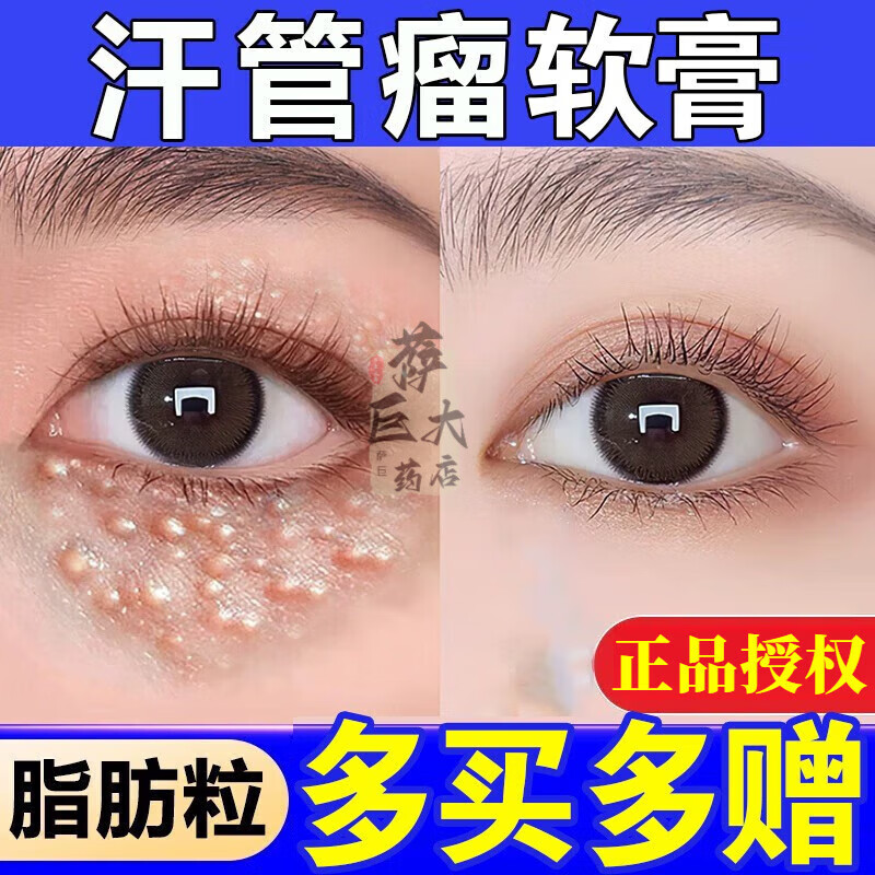 邹润安汗管瘤抑菌去除膏脂肪粒非去除神器减少眼周白色颗粒男女眼部非