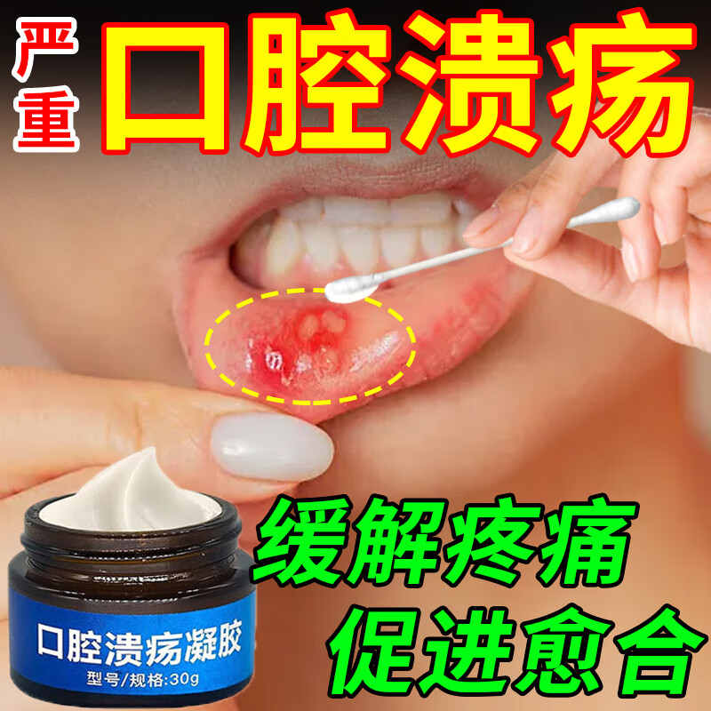 口腔溃疡凝胶膏口疮疼痛唇内侧舌头舌腹颊黏膜前庭沟软腭口腔溃疡贴