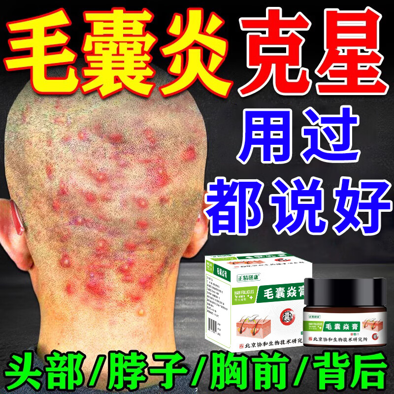 毛囊炎头部专用膏药头上长疙瘩脓包头皮痒止痒溢脂性皮炎专用膏 单盒