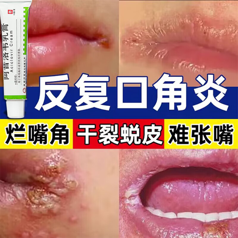 口角炎专用药膏 烂嘴角嘴唇干裂专用药 嘴巴起泡烂嘴唇炎嘴上起泡脱皮