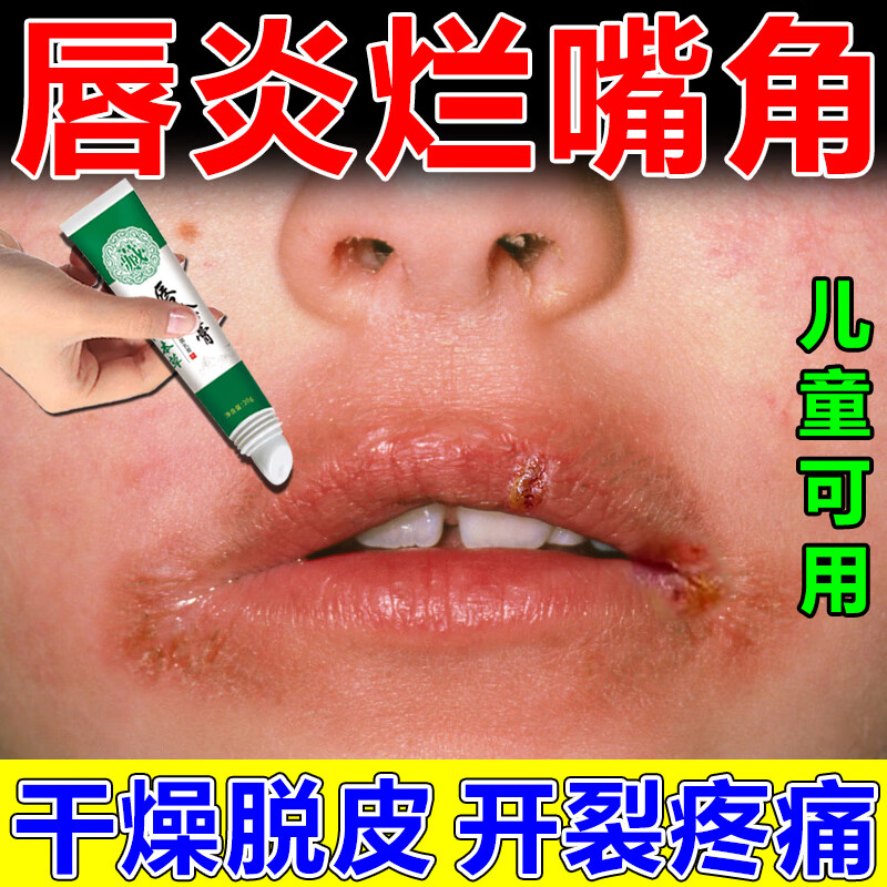 嘴角溃烂软膏口角炎嘴角干裂开裂疼痛唇膏唇炎口周皮炎嘴巴疱疹儿童舔