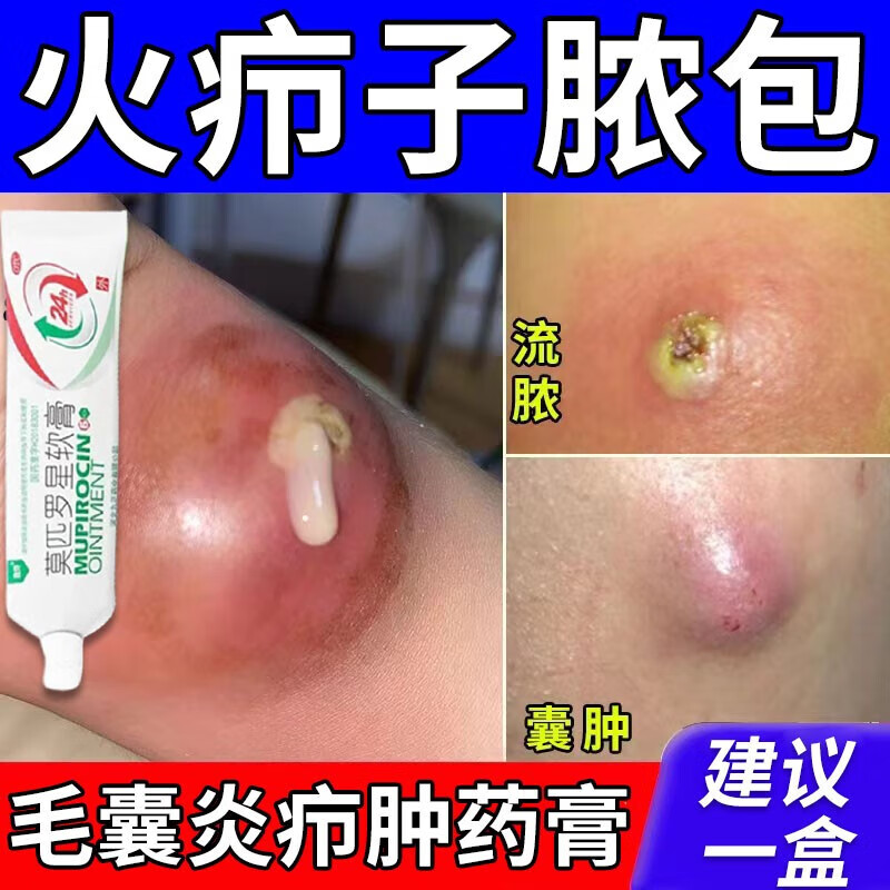 皮脂腺囊肿的药膏治皮屁股下面长痘皮下脓包火疖子坐板疮脓包结节化脓